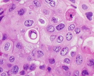 Corista Lung Cancer Image